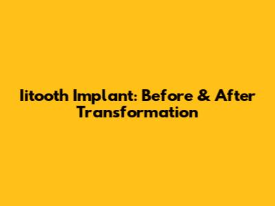 Iitooth Implant: Before & After Transformation